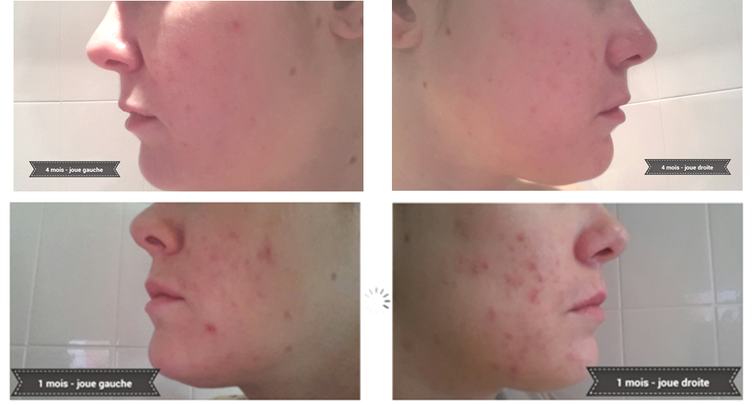 Accutane 30mg