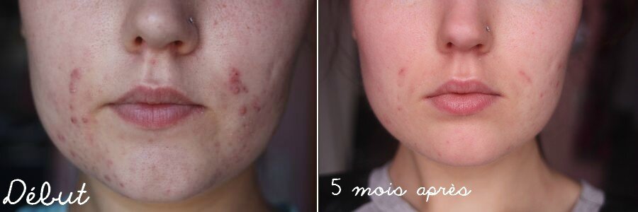 roaccutane comprimé prix