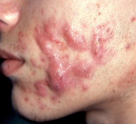 Roaccutane Prix Acné