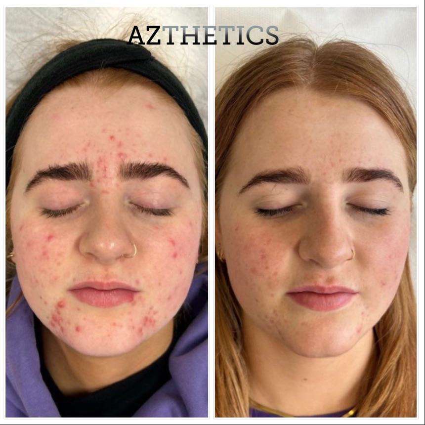 roaccutane sans contraception
