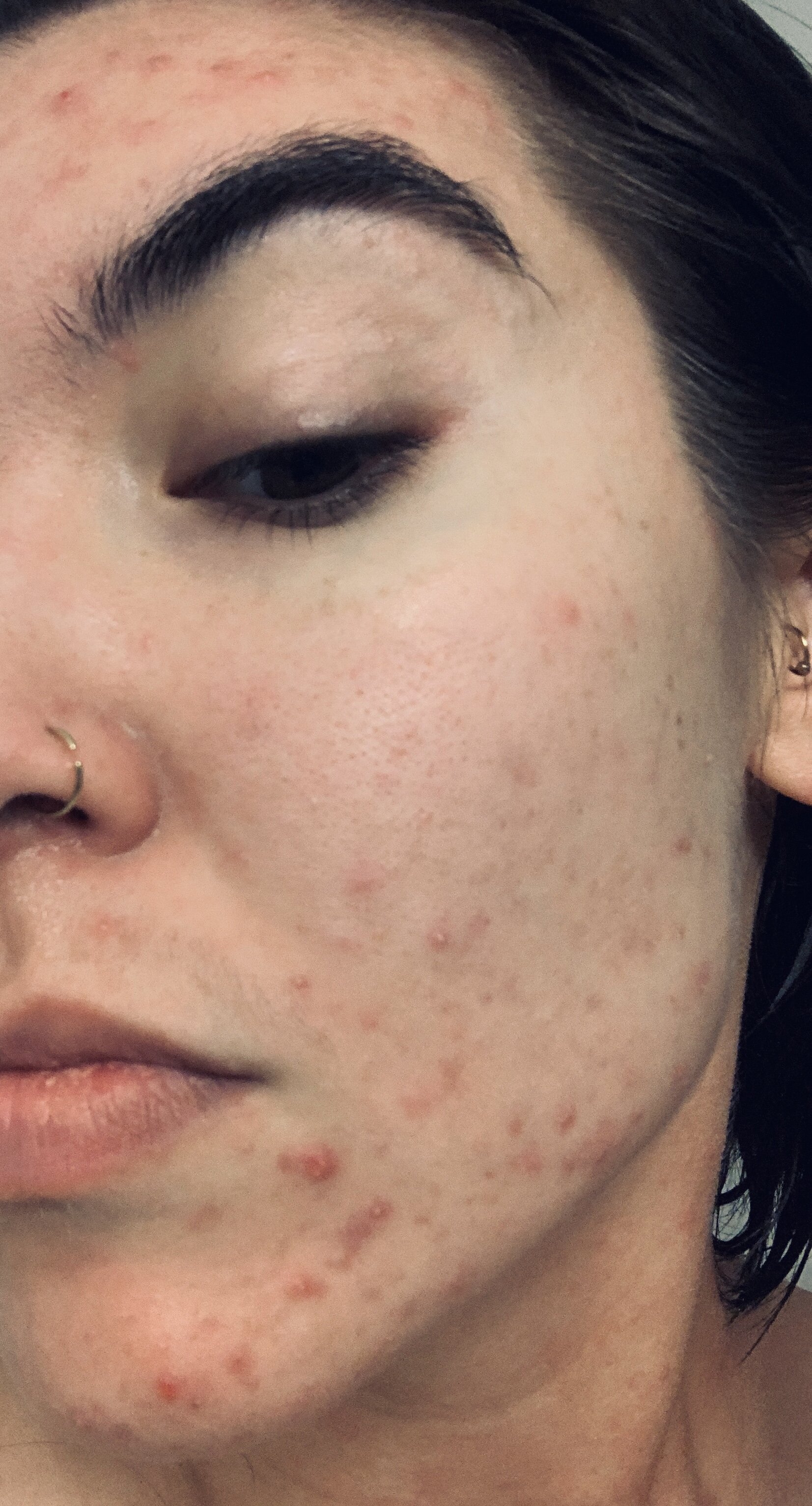Commander accutane