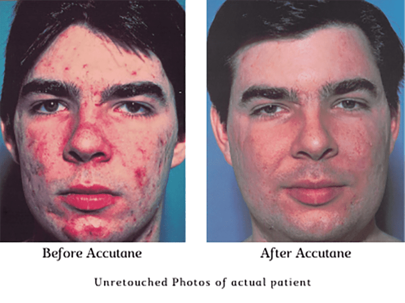 Online Dermatologist Accutane