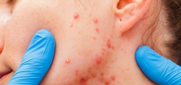 Ordre Accutane