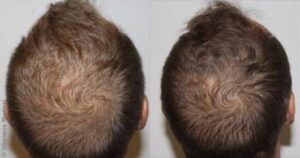 Acheter finasteride bailleul