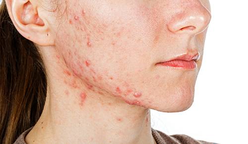Accutane comment acheter