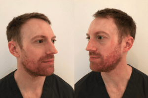 Accutane Moins Cher