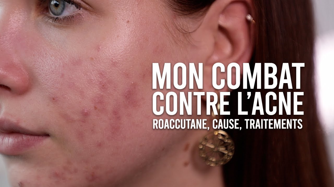 Roaccutane moins cher
