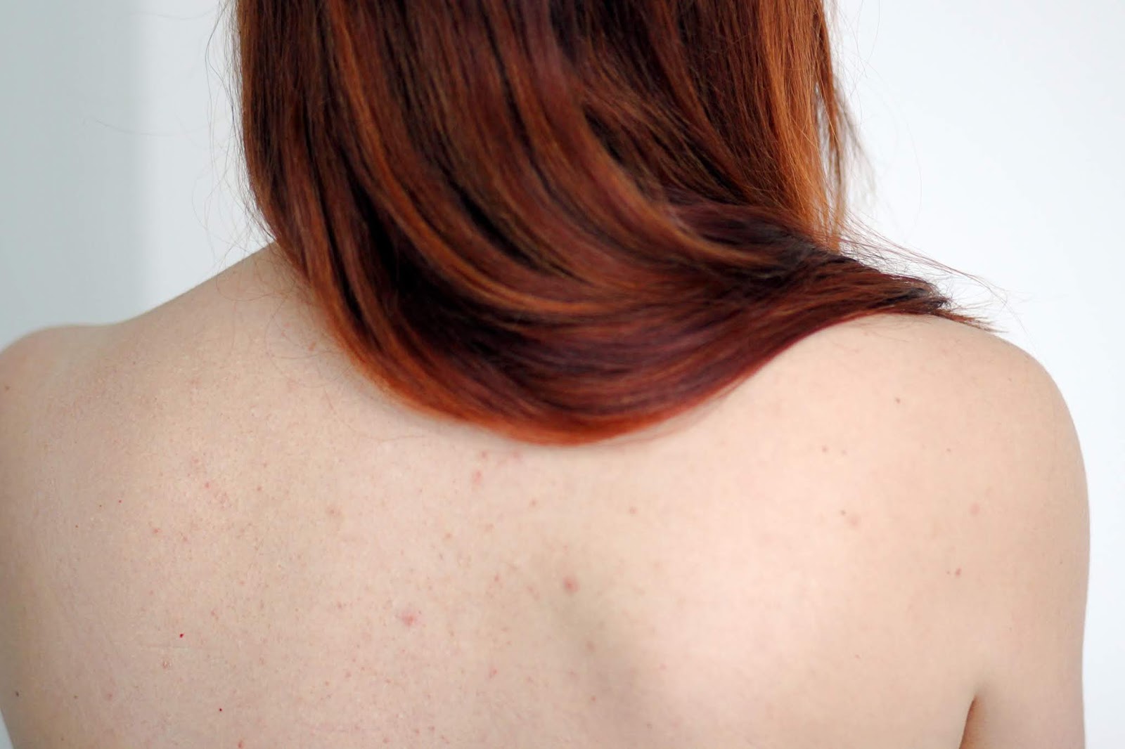 roaccutane sans pillule