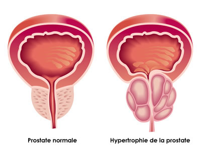 finpecia générique