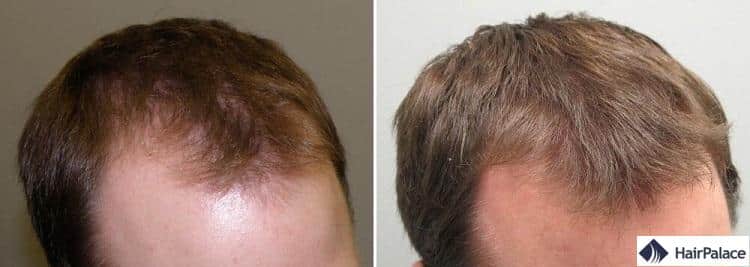 Ou acheter finasteride