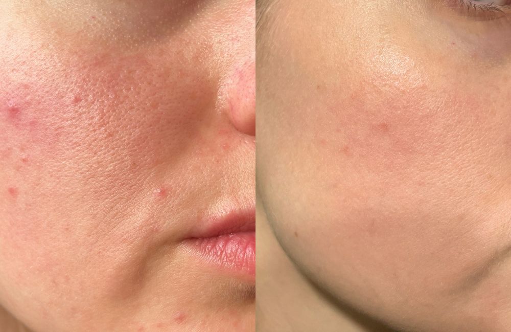 Online dermatologist accutane