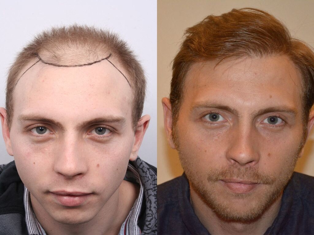 finasteride france prix