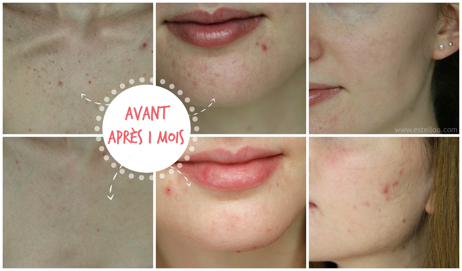 achat de roaccutane