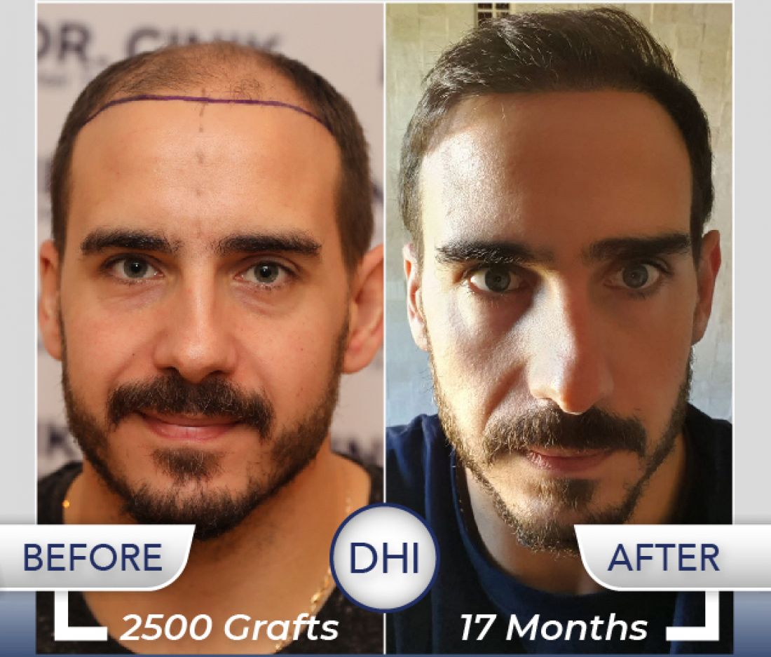 Finasteride en ligne