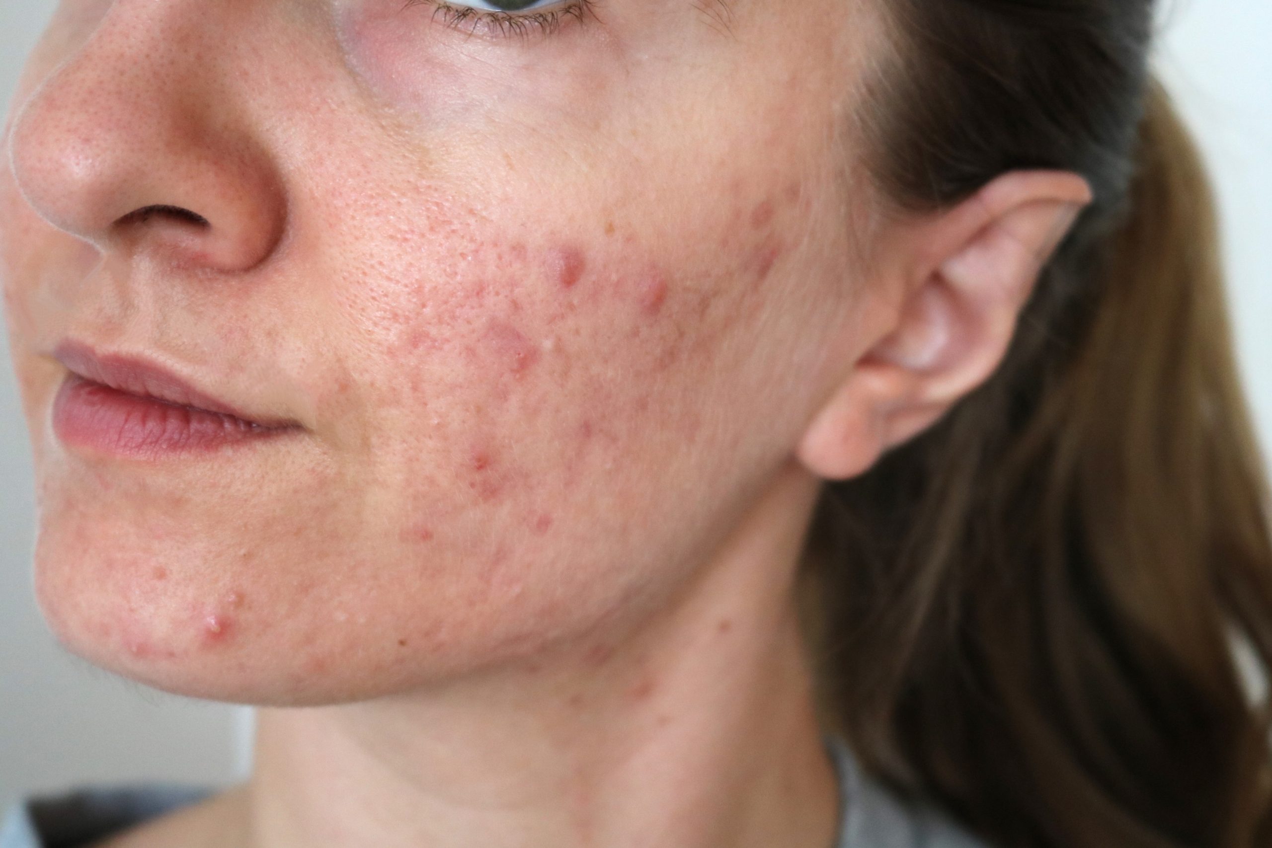 roaccutane pilule obligatoire