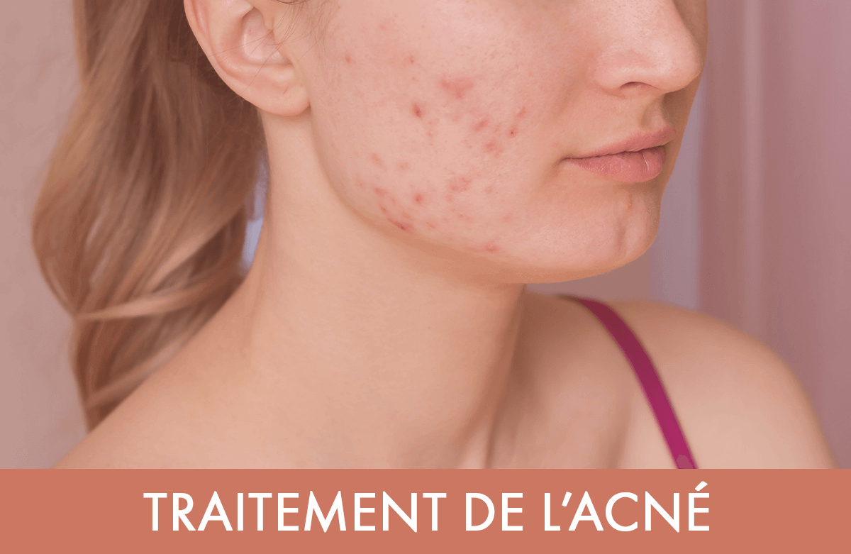 Prix medicament roaccutane