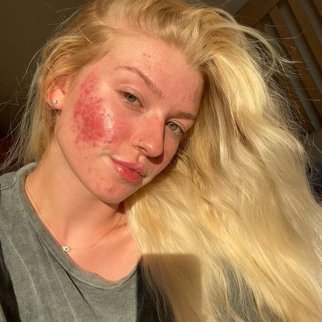 Acheter roaccutane gel