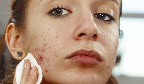 Isotretinoin acheter sans ordonnance