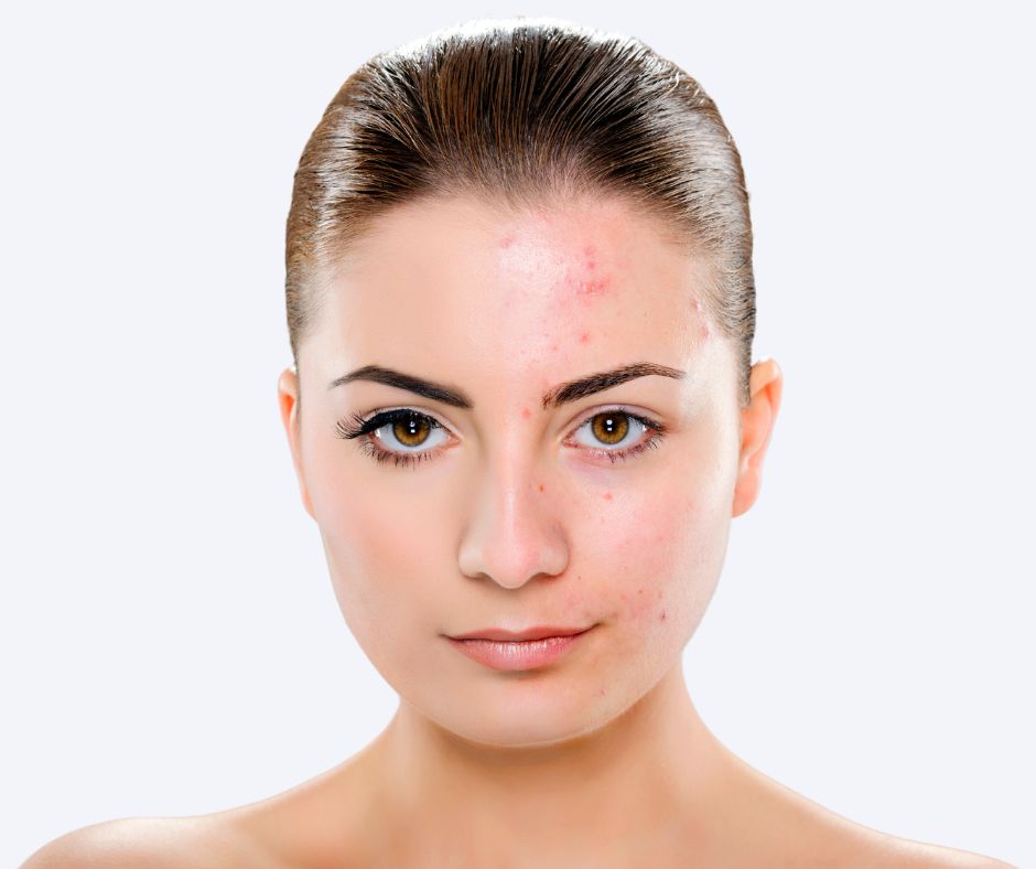 roaccutane ordonnance en ligne