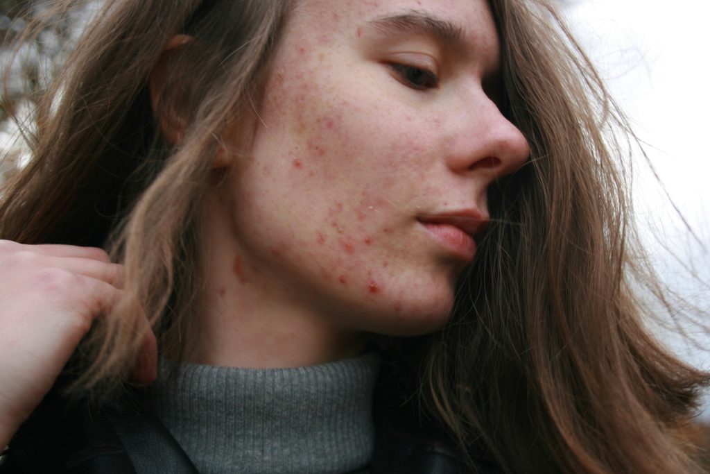 Accutane Où Acheter