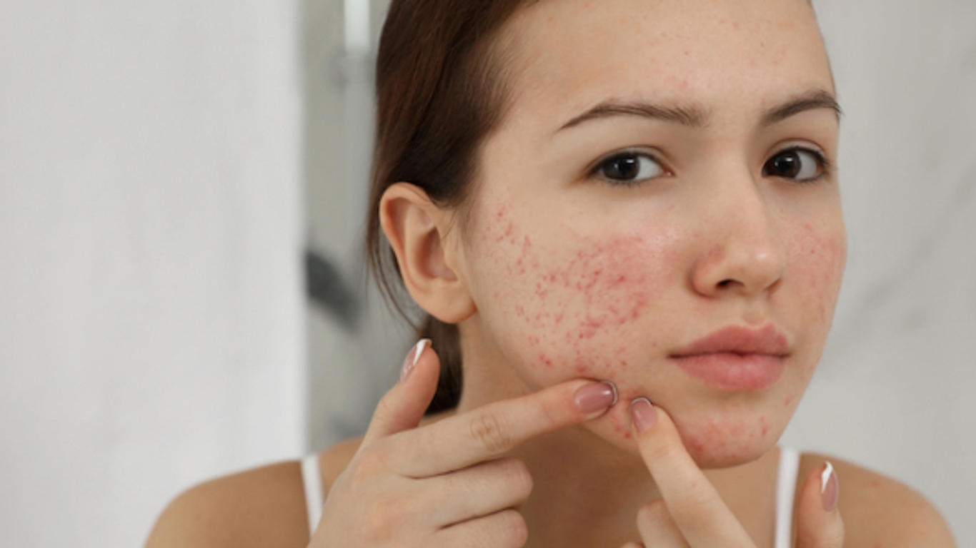 Avoir Roaccutane Sans Ordonnance