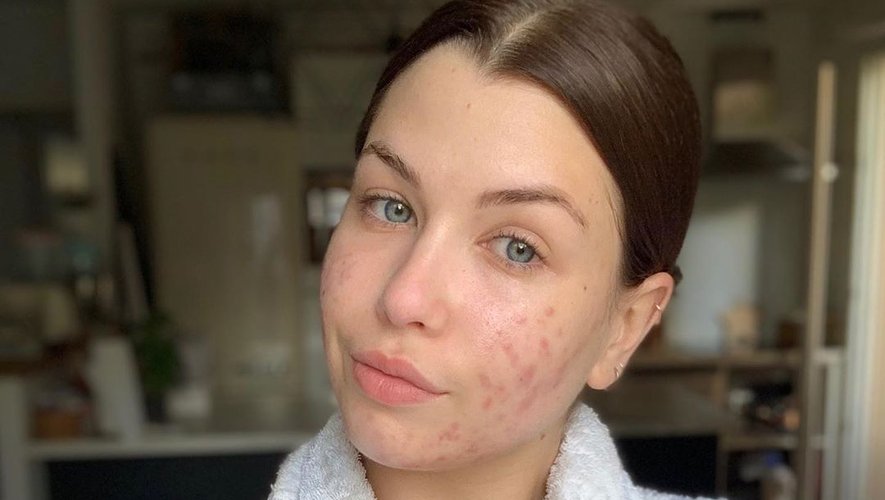 roaccutane quelle pilule