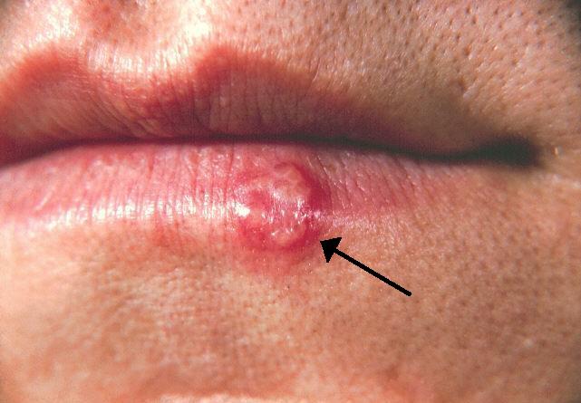 Aciclovir eg labialis prix