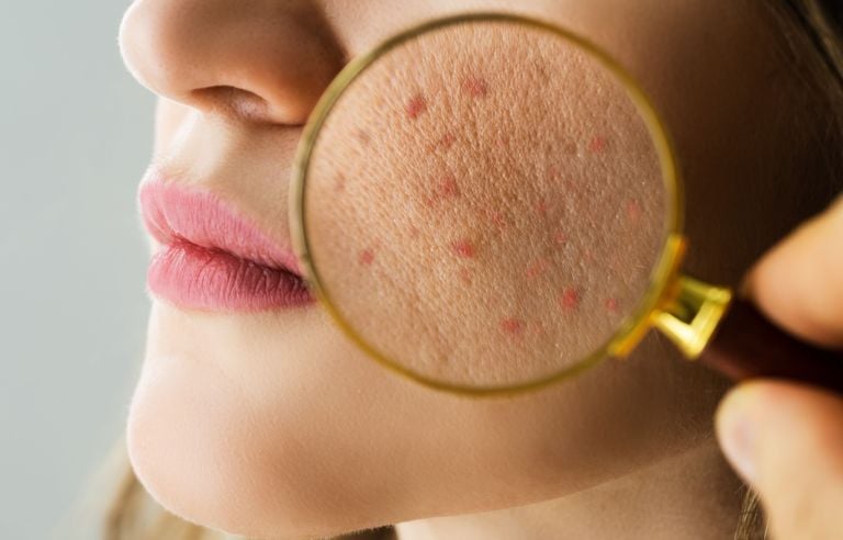 Interdiction Accutane France
