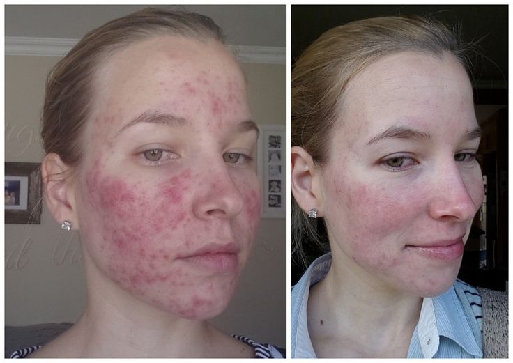 roaccutane gel generique