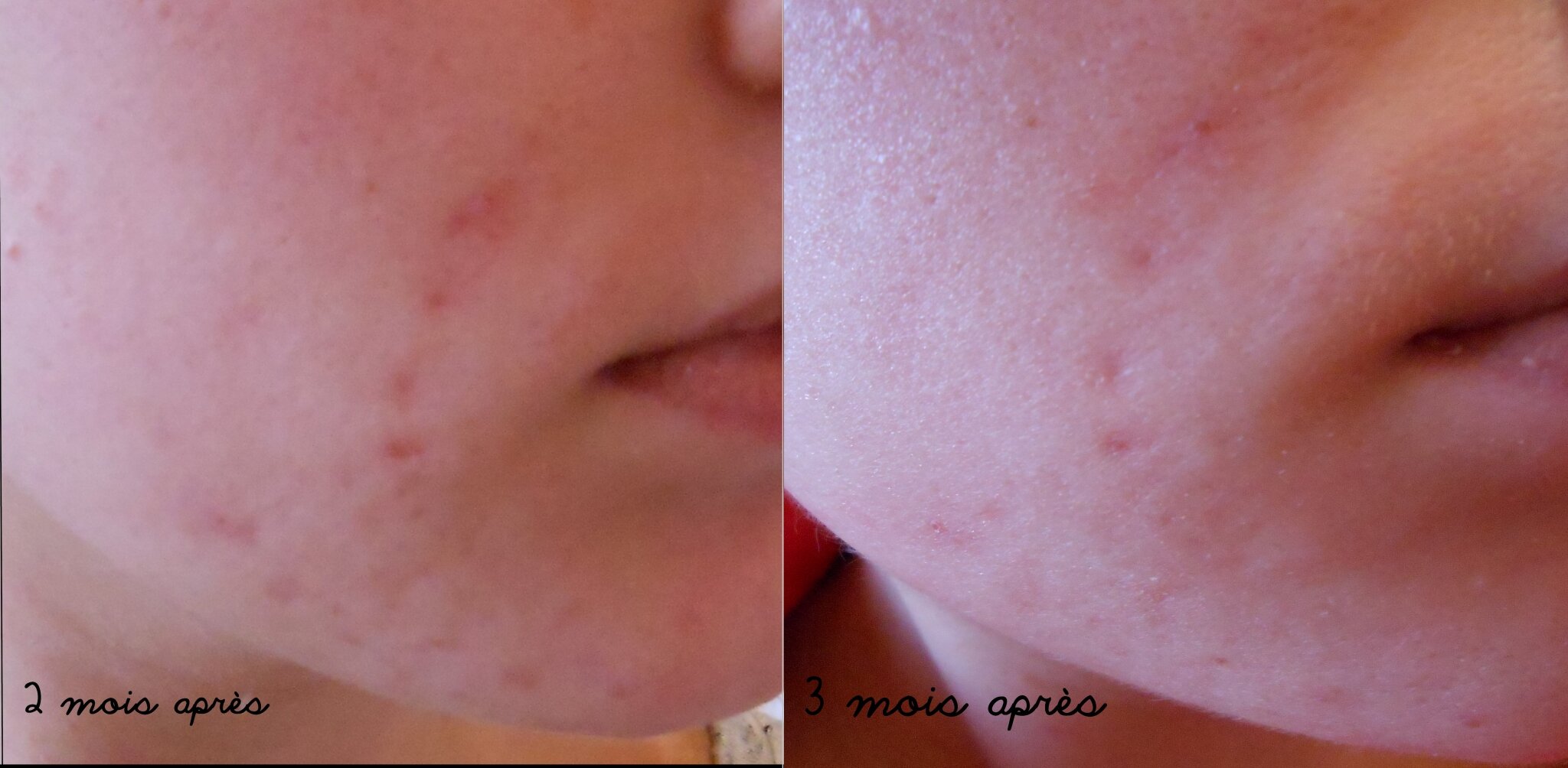 pilule apres roaccutane
