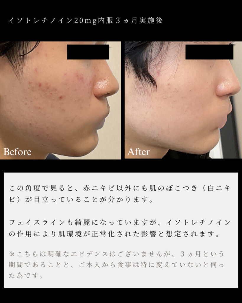 commander du isotretinoin