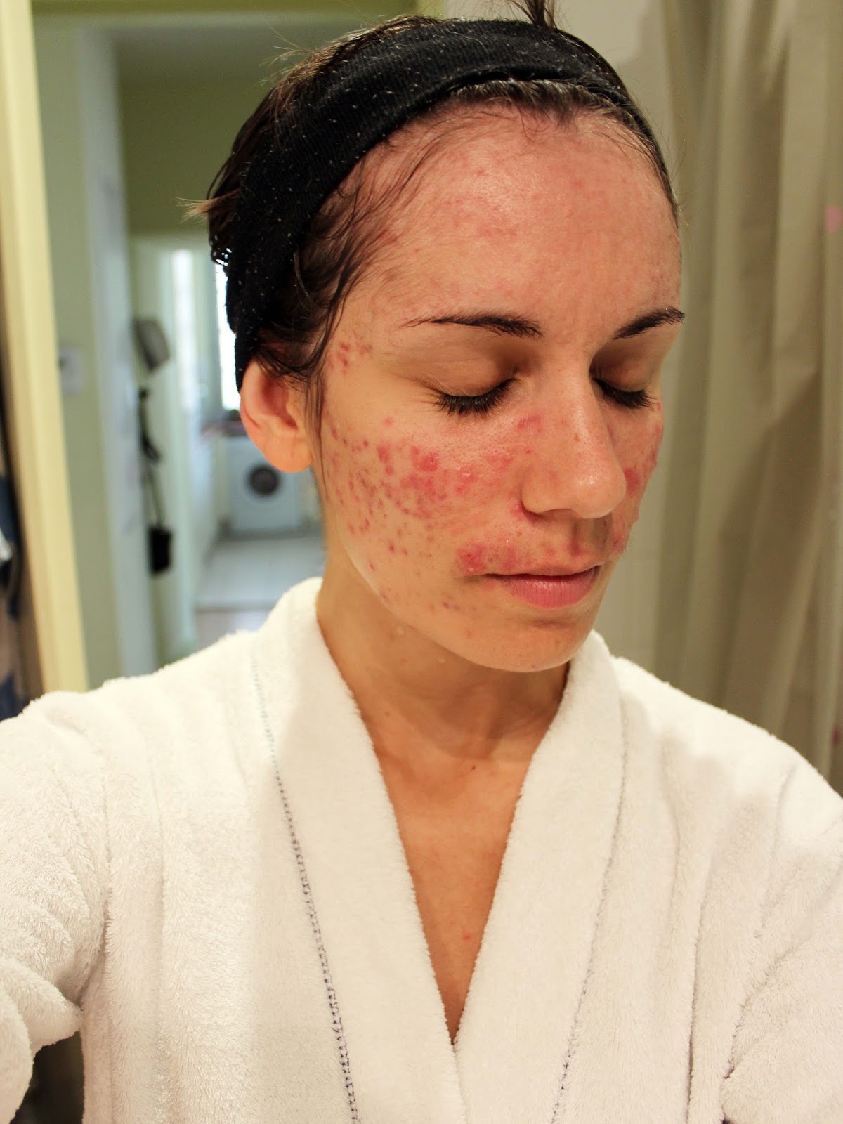 Roaccutane en france