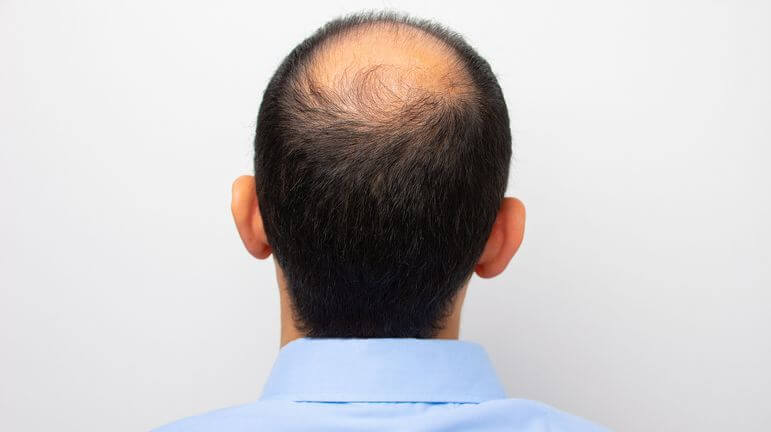 commander du finasteride