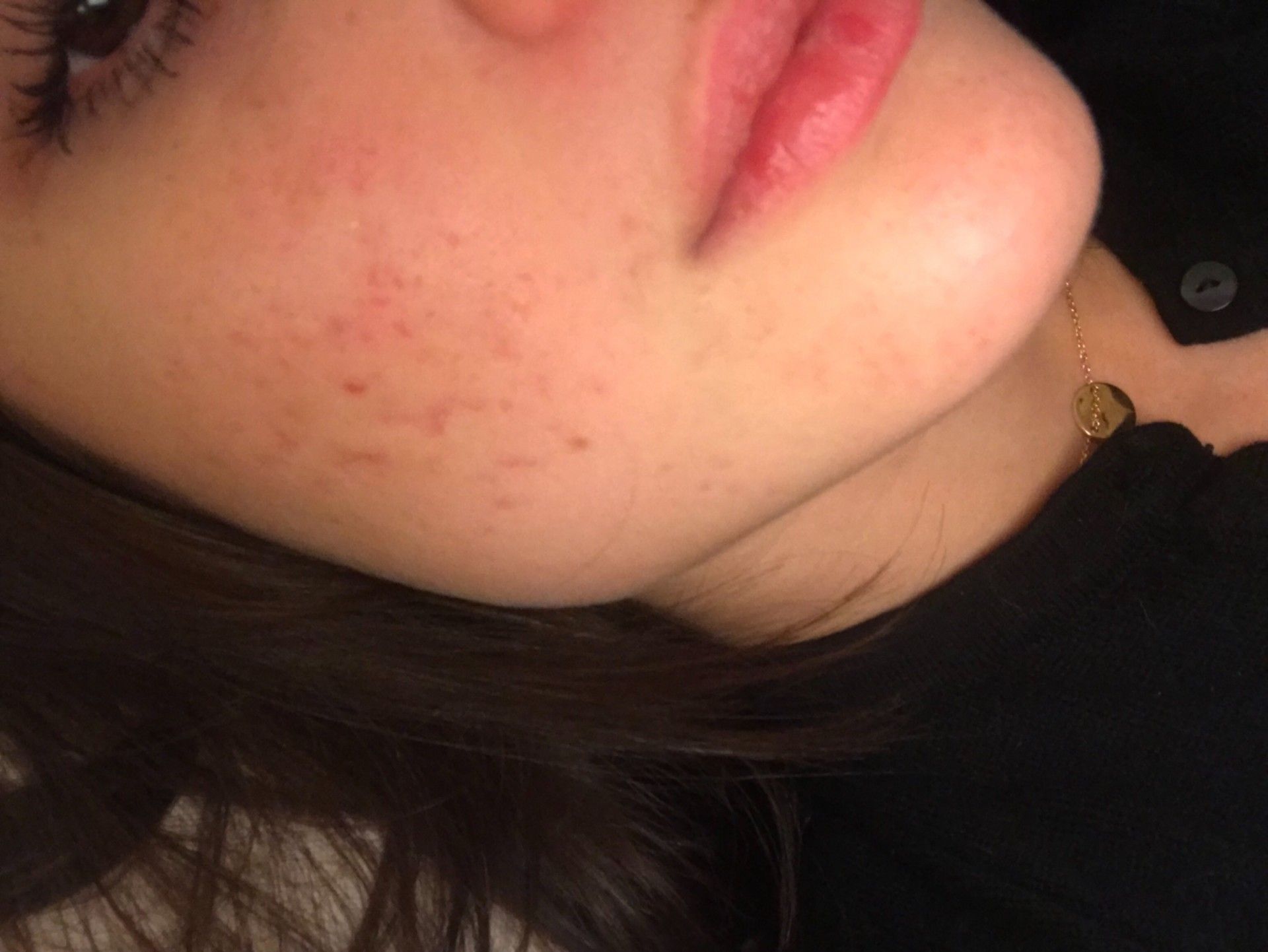 Prix Traitement Roaccutane