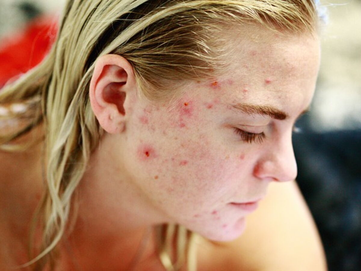 Roaccutane avec pilule