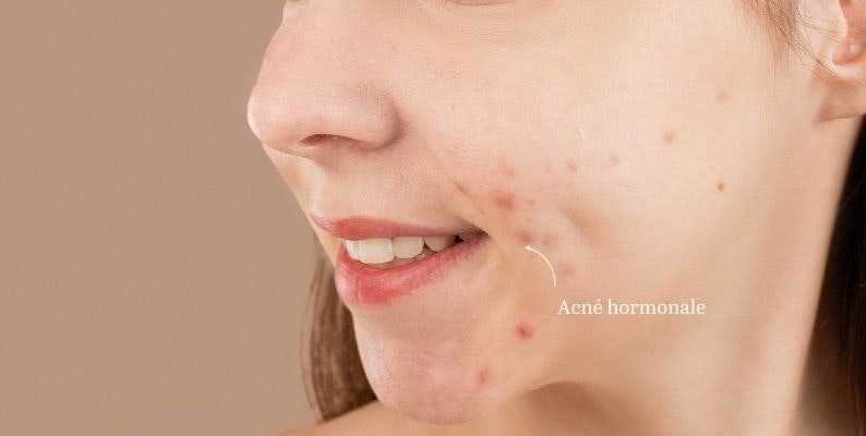 roaccutane sans pilule