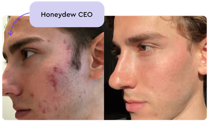 Accutane pas cher