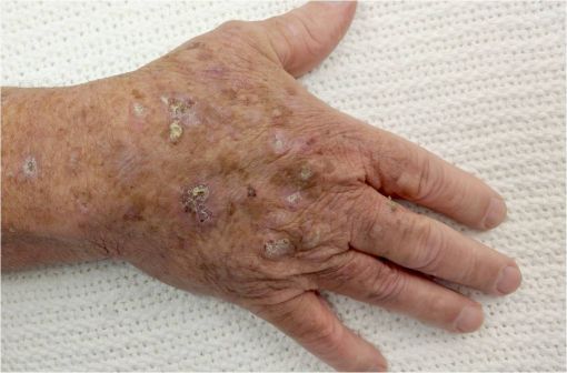 Imiquimod avec ou sans ordonnance