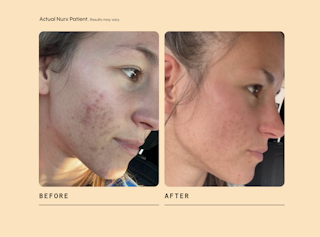 Accutane Acheter En Ligne