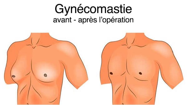 Prix tamoxifène