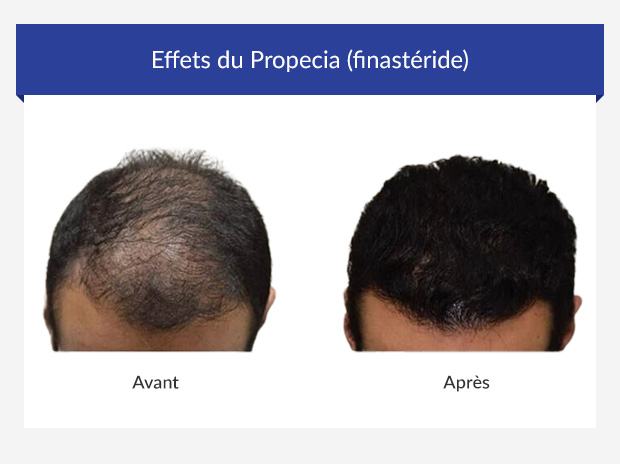 prix pour finasteride