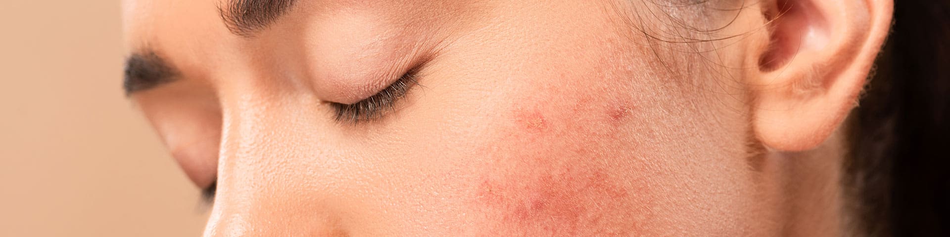 Roaccutane 10mg online