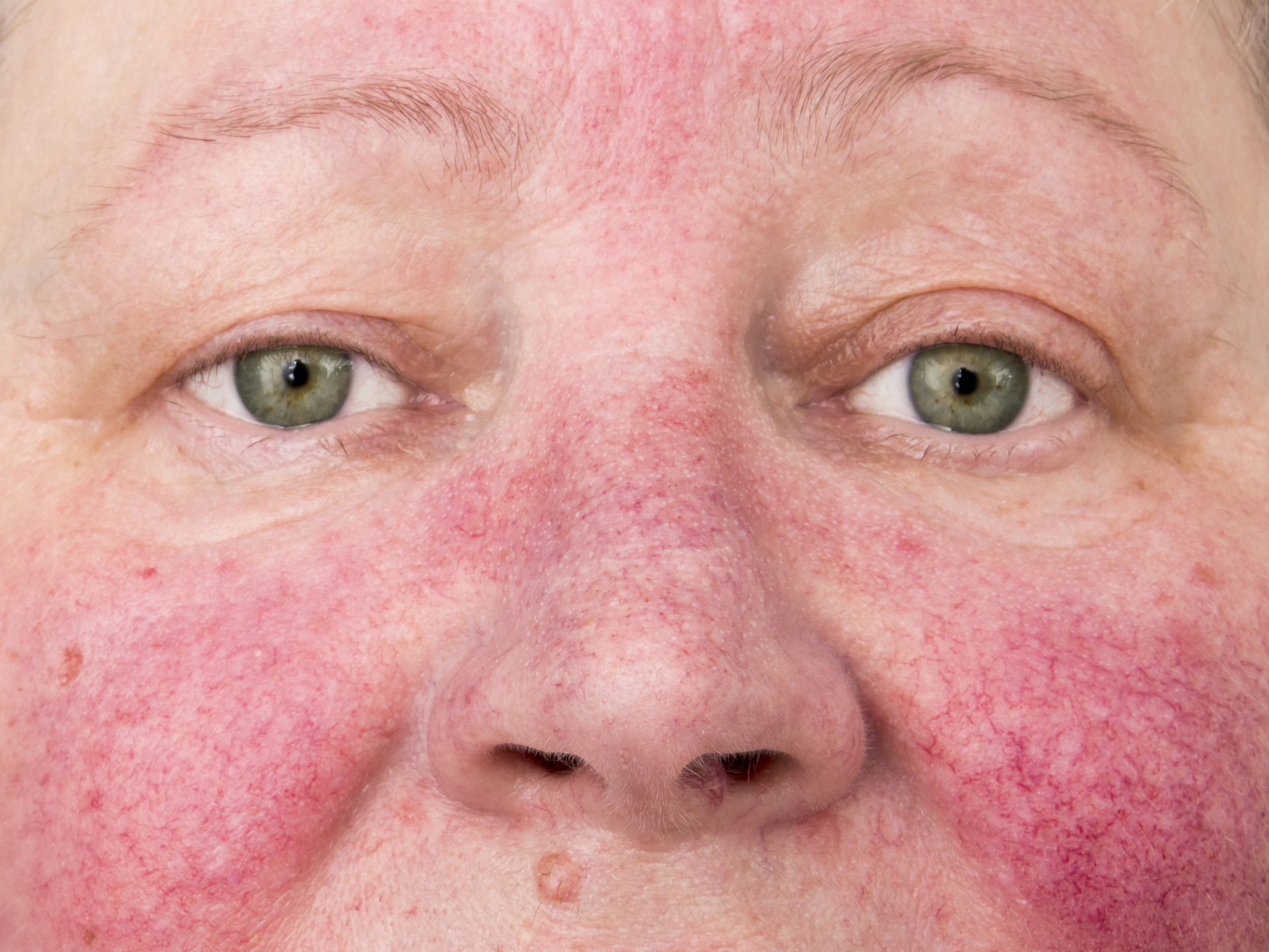 Isotretinoin 40mg