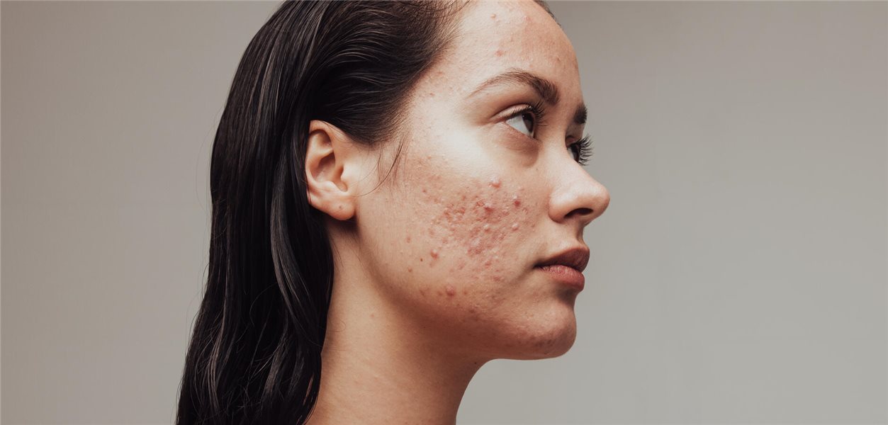 Accutane online eu