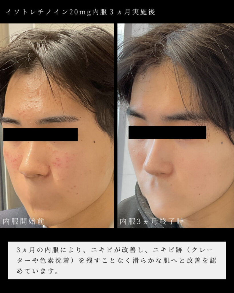 Accutane online europe