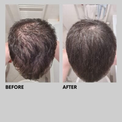 Finasteride gel online
