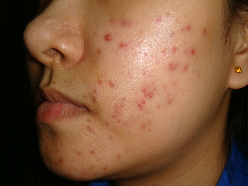 où acheter roaccutane