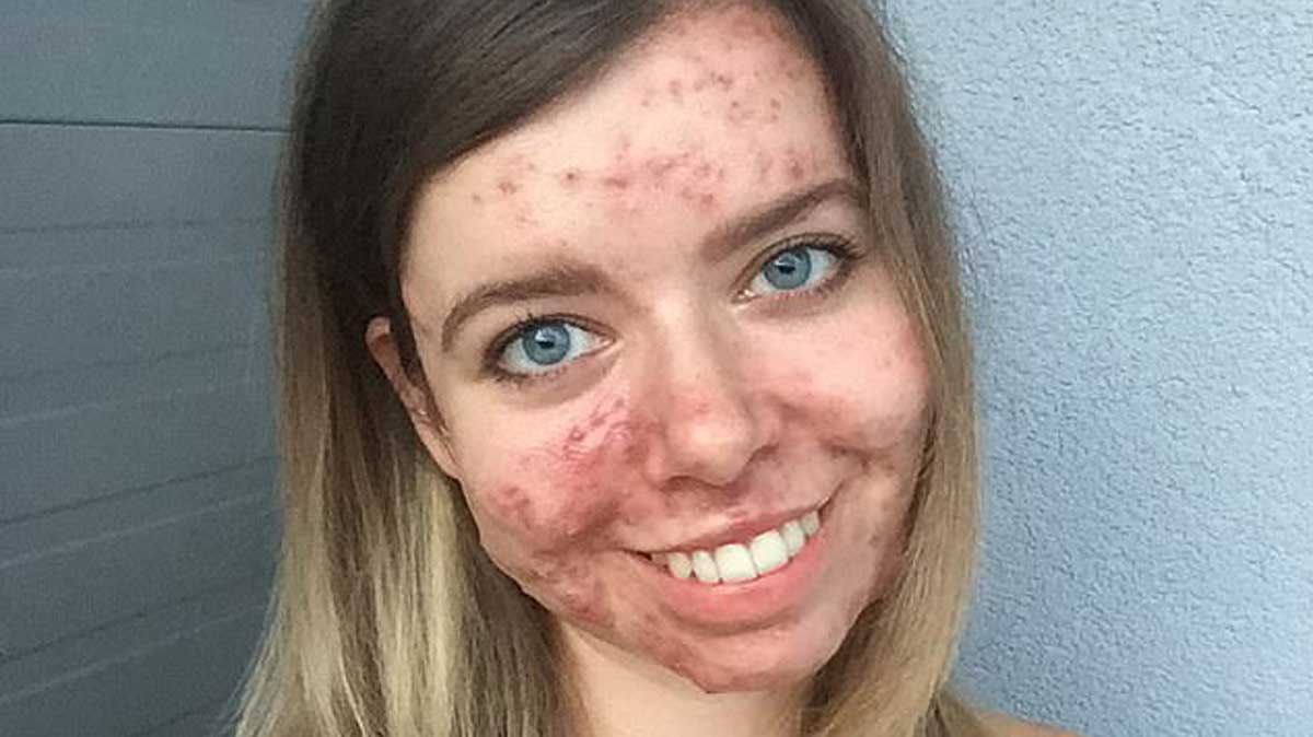 pilule de roaccutane