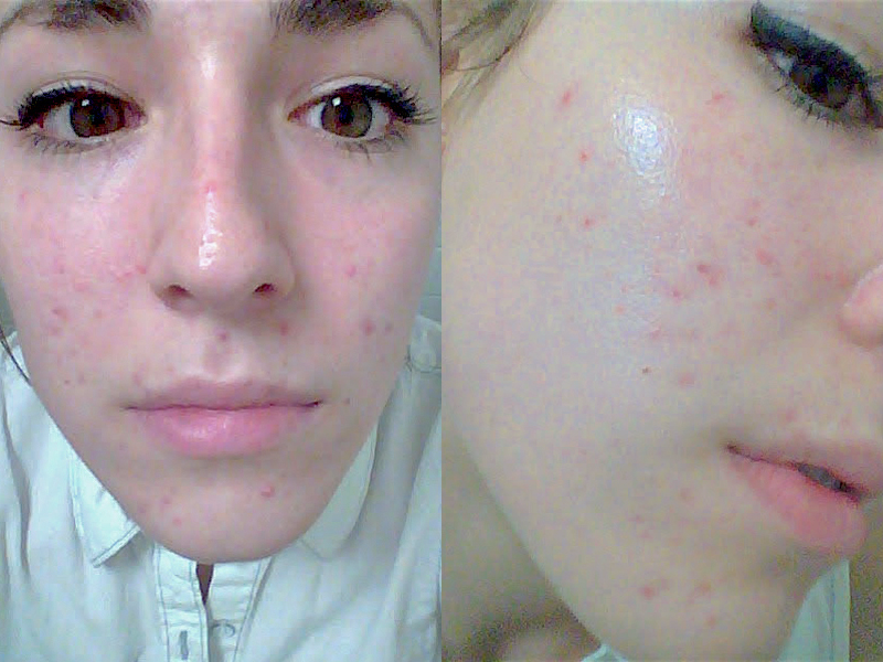Commander accutane