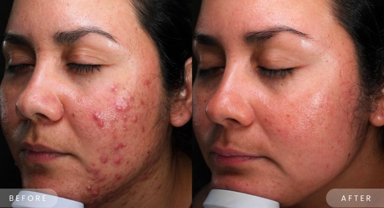 coût du accutane
